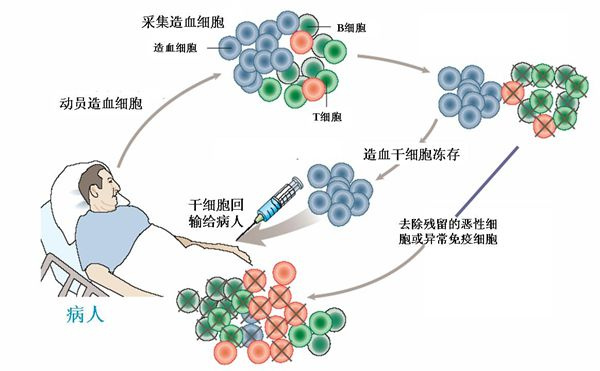 白血病干細(xì)胞移植1.jpg